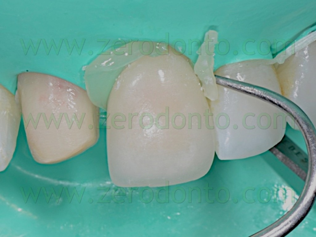 [116-eliminazione-cemento-in-eccesso-%255B1%255D.jpg]