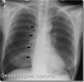 Oesophageal rupture. Air is seen outlining the right side of the mediastinum