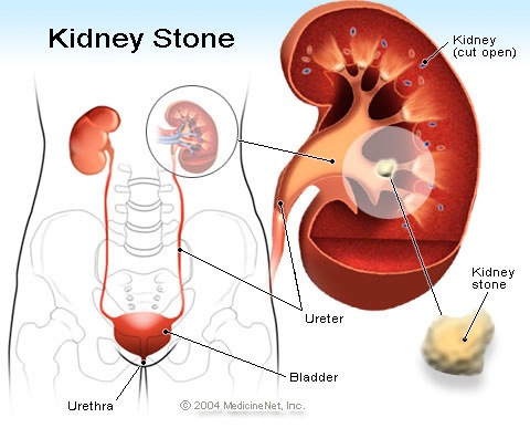 [kidney_stone%255B3%255D.jpg]