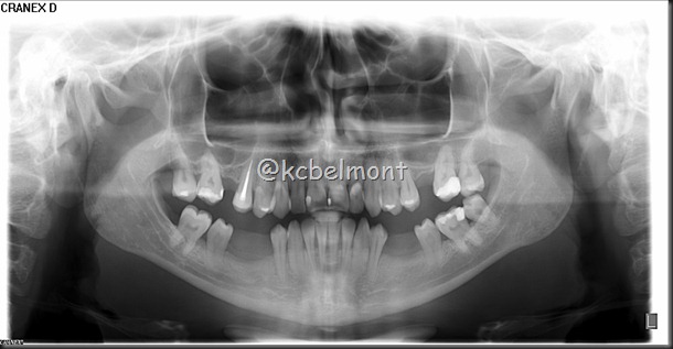 migração dos elementos 35 e 45 migração dos elementos 35 e 45