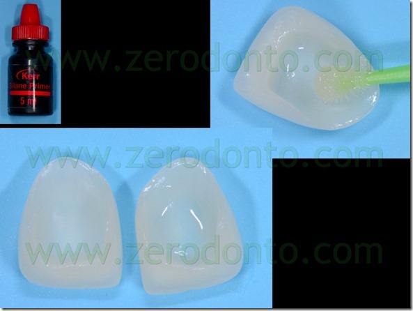 107 silanizzazione con silano faccette ceramica
