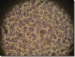 Microcytic anemia photograph of histo slide