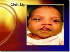 cleft lip medicalshow