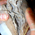 heart_papillary_muscle.JPG