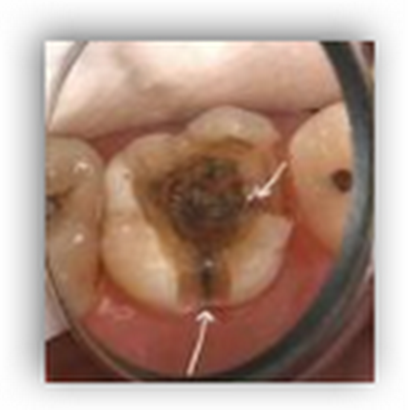 Unemployed Man With No Health Insurance Dies When Tooth Infection Spread to His Brain–Couldn’t Afford the Antibiotics