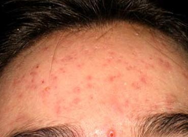 [acne-NTNVa%255B7%255D.jpg]
