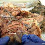 brachiocephalic_artery_L.JPG