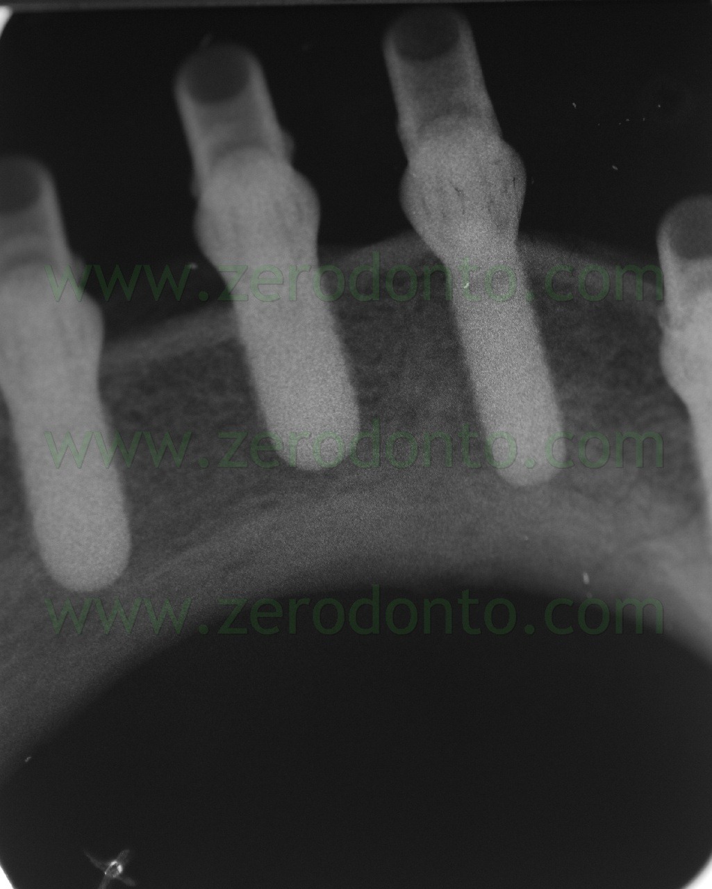 [radiografia%2520ednorale%2520impianti%2520straumann.jpg]