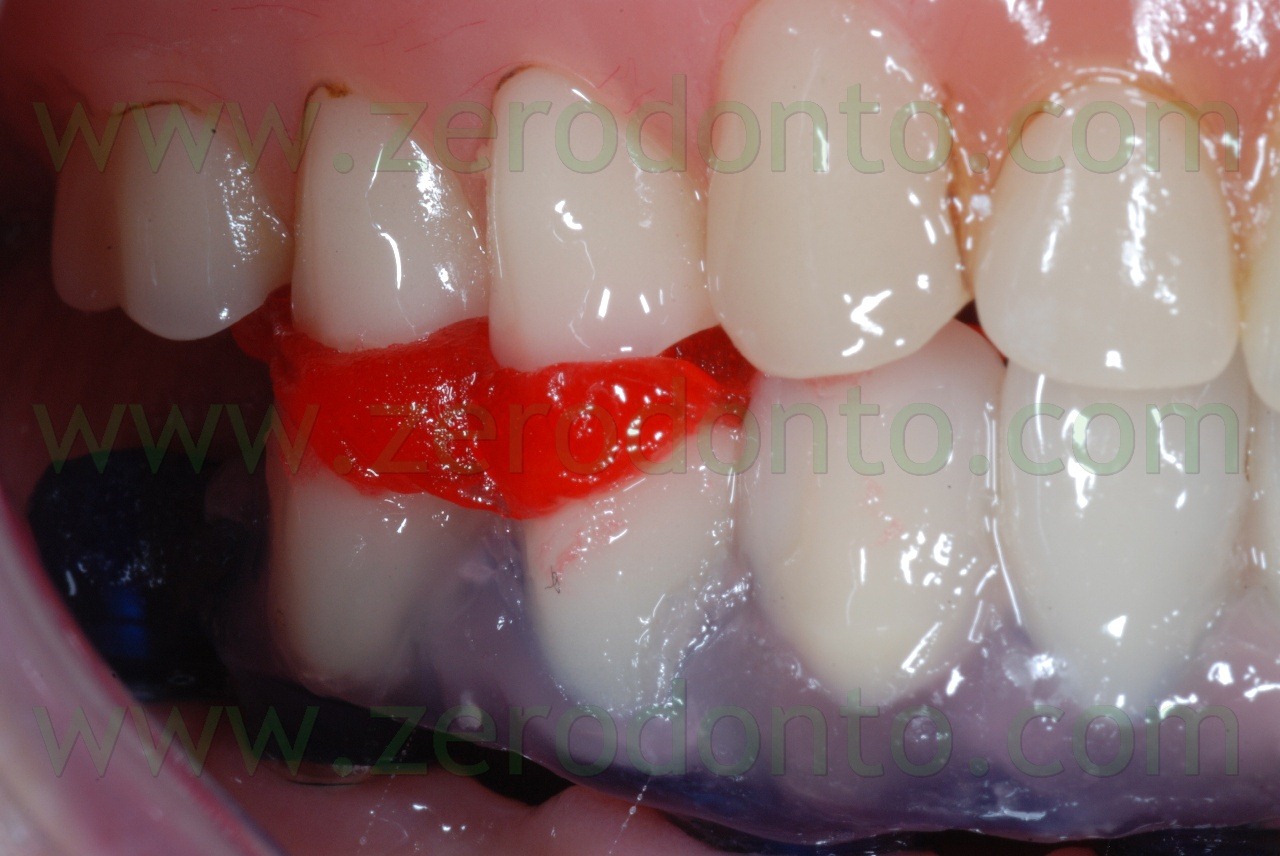 [pattern-resin2.jpg]