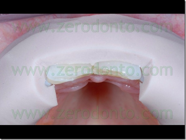 52 preparazione margine incisale faccette ceramica