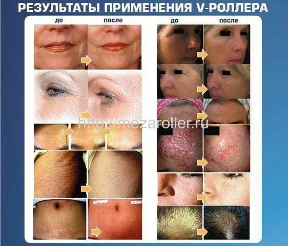 Мезотерапия в лицо в домашних условиях 984