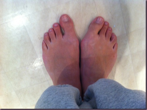 hallux valgus1 hallux valgus1