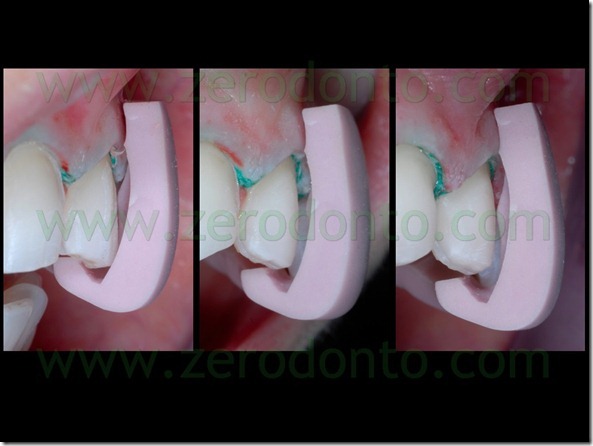 68 rifinitura preparazioni veneers ceramica