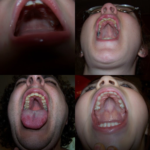  ... looks like. It is a diagnostic feature of Ehlers-Danlos Syndrome