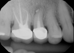 Endo Retx 3.jpg