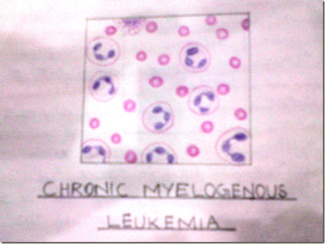 chronic myelogenous leukemia-cml-histopathology