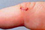 M3300703-Close-up_of_a_small_cut_healing_on_a_finger-SPL M3300703-Close-up_of_a_small_cut_healing_on_a_finger-SPL