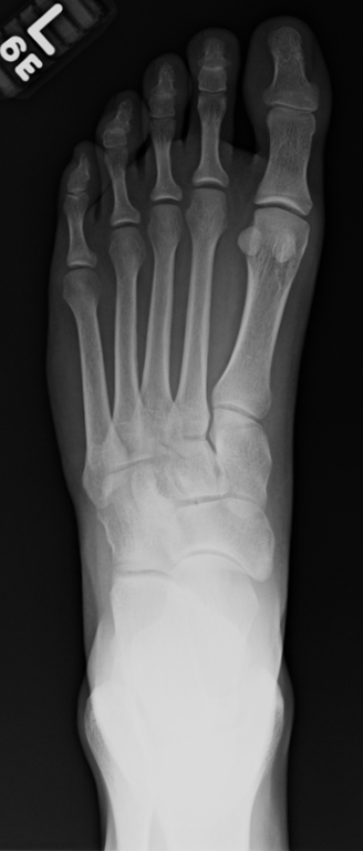 [Foot%2520Xray%255B2%255D.png]