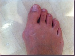 hallux valgus2 hallux valgus2