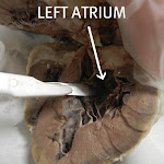 heart_atrium_labeled.JPG