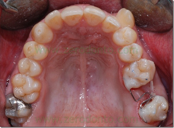 14 chiusura spazi denti
