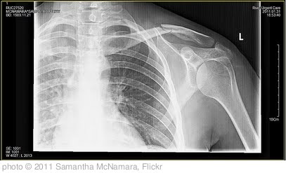 'Clavicles hurt when they break.' photo (c) 2011, Samantha McNamara - license: http://creativecommons.org/licenses/by/2.0/