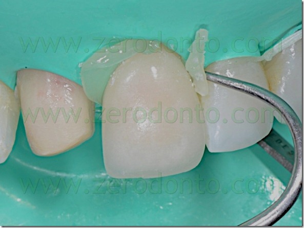 116 eliminazione cemento in eccesso porcelain veneers