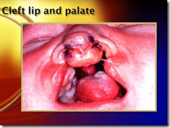 cleftlip and palate