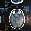 BrandieBrainTumor 001.jpg