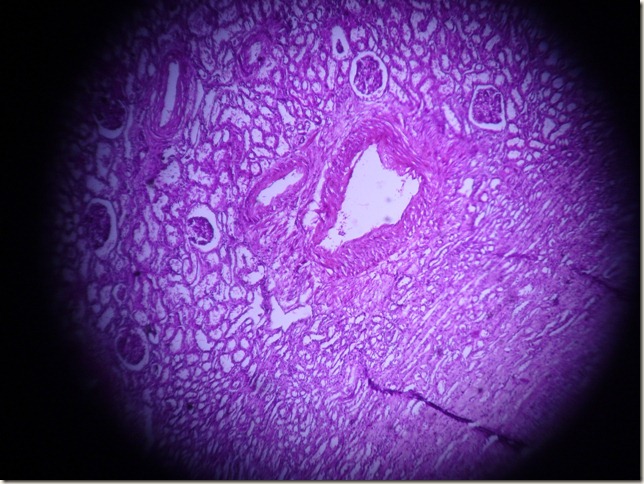 renal cell carcinoma histopathology