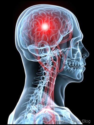 Brain(1) Brain(1)