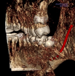 #32 impaction 3D.jpg