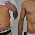 Lipo2.png