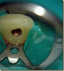 Photo Apical Gutta Percha013