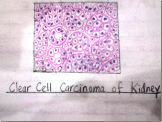 clear cell carcinoma of kidney histopathology diagram