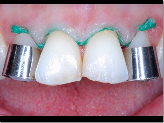54 matrici protezione preparazione denti