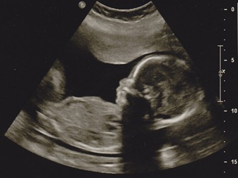 2012-01-11 ultrasound 2