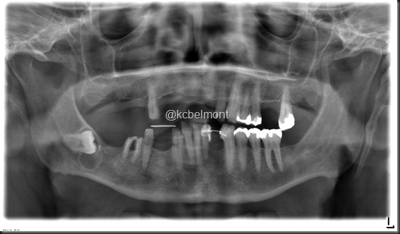 cisto dentígero cisto dentígero
