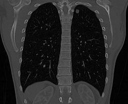 [lung-art.jpg]