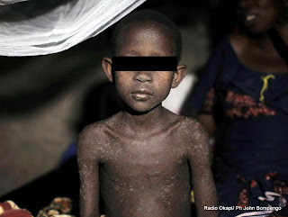 Un enfant sous traitement pour la rougeole dans l'hôpital de Baraka, appuyé par MSF, dans le sud-Kivu. Photo MSF 2010