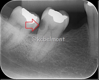 47 crie periapical 47 crie periapical