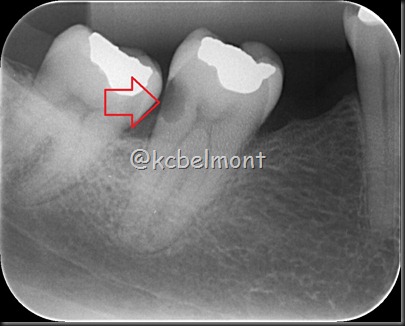 47 crie periapical