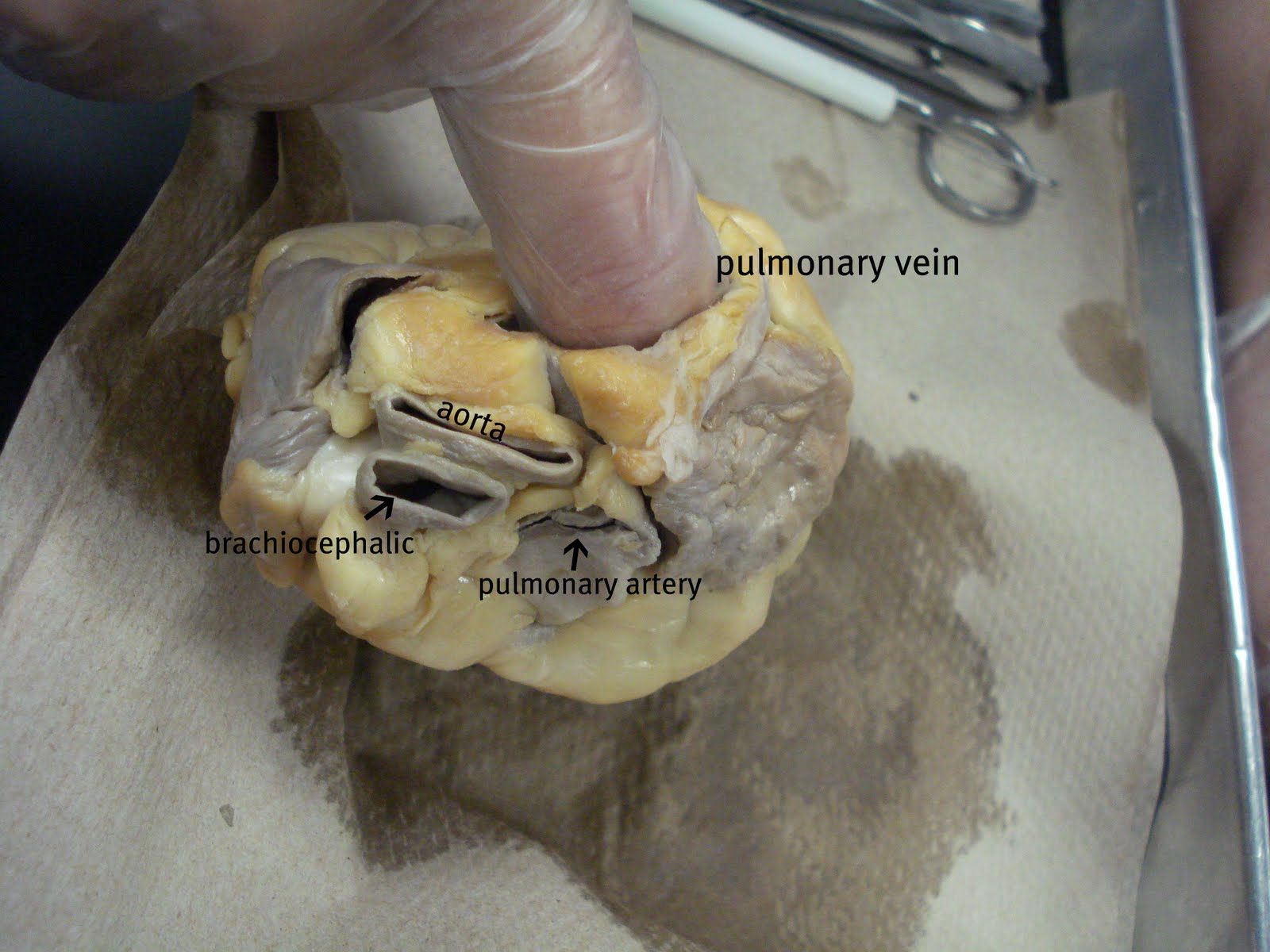 The vessels at the top of the heart, identified