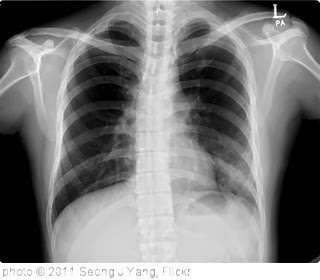 'My chest film' photo (c) 2011, Seong J Yang - license: http://creativecommons.org/licenses/by-sa/2.0/