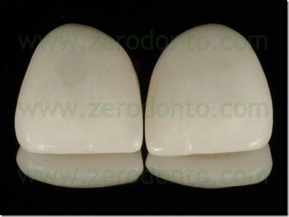 95 faccette ceramica feldspatica