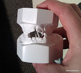 This was her original mouth structure. She had pushed up her teeth from thumbsucking. This was her original mouth structure. She had pushed up her teeth from thumbsucking.