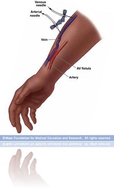 Fistula