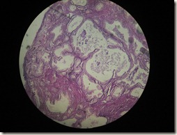 BPH high resolution histology slide tsnaps BPH high resolution histology slide tsnaps