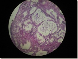 BPH  high resolution histology slide tsnaps