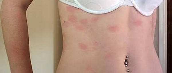 10- Alergia à água 10- Alergia à água